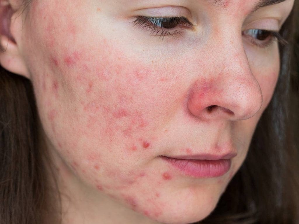 Discover the best probiotics for skin and gut health + top probiotics for skin health