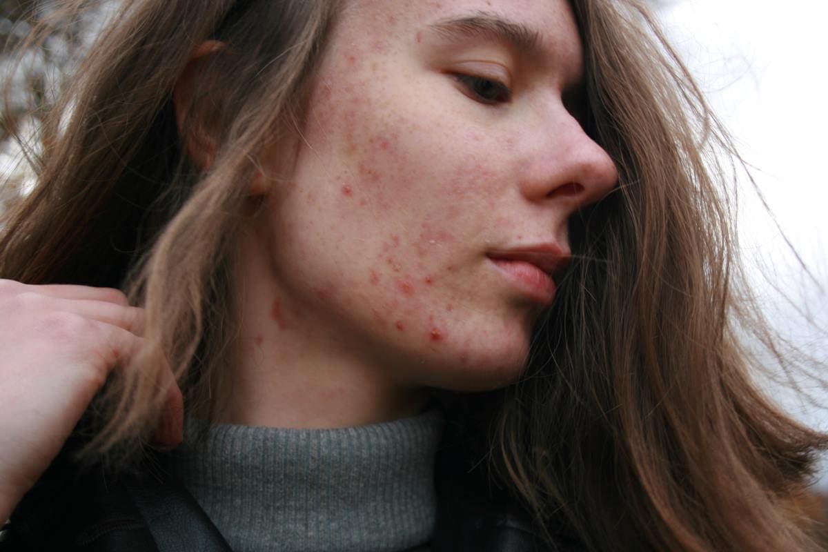 What are the best probiotics for skin and gut health, and how can probiotics help calm skin inflammation and soothe your digestive system?